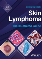 Skin Lymphoma